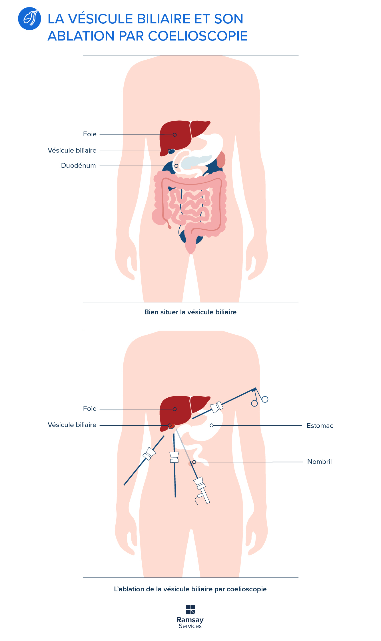 Tout savoir sur l’ablation de la vésicule biliaire par coelioscopie Tout savoir sur l’ablation de la vésicule biliaire par coelioscopie